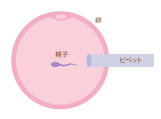 図：顕微授精