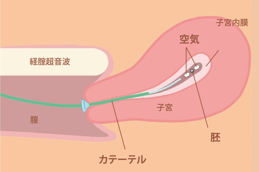 図：胚移植