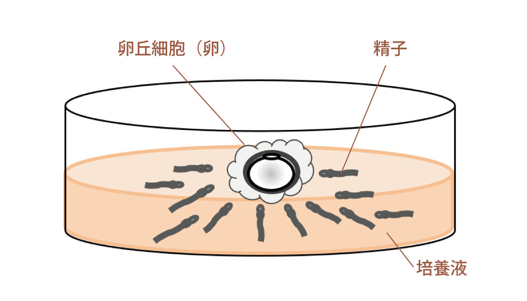 図：体外受精