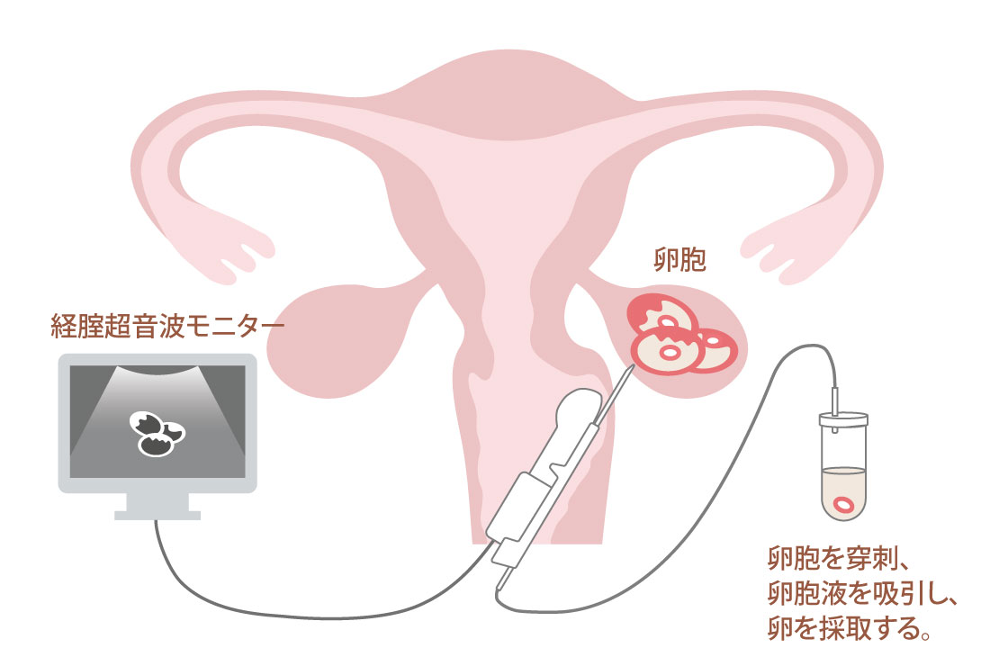 図：採卵