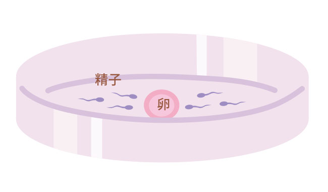 図：体外受精