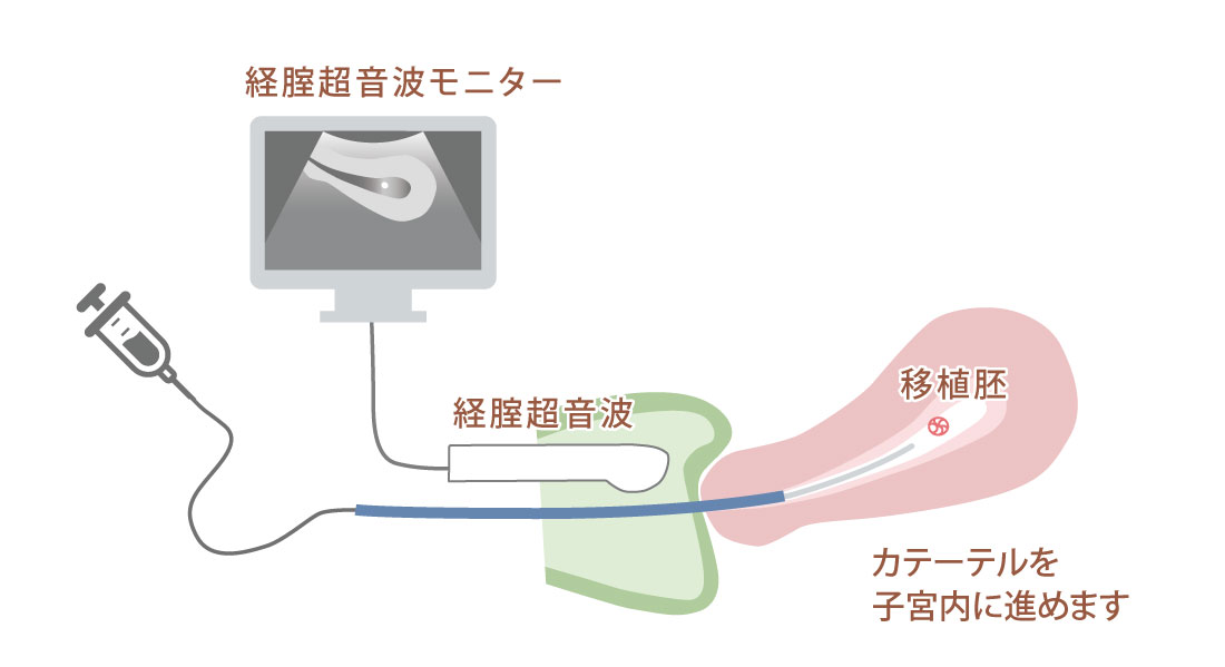 図：胚移植