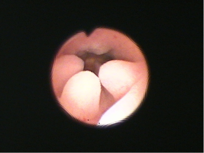 Photo:子宮内膜ポリープ1